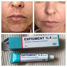 قل وداعا لمشاكل النمش الكلف والندوب مع كريم المعجزة Expigment créme pour visage 4%